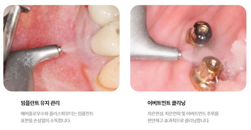 불당본점 서울비디치과의원, 천안에서는 치료 전후 철저한 검진과 모니터링으로 안심하고 치료를 받을 수 있습니다.