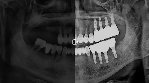 불당본점 서울비디치과의원, 천안 임플란트로 완벽한 입체 치아 복원